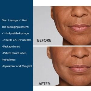 Restylane Defyne Lidocaine Dermal Filler